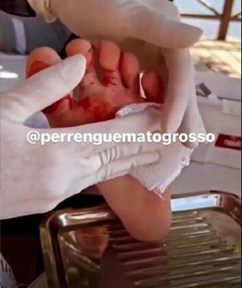 Crianças são atacadas por piranhas no Lago do Manso e ficam com pés mutilados Crianças são atacadas por piranhas no Lago do Manso e ficam com pés mutilados